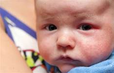 換季寶寶皮膚問題多，嬰兒濕疹避坑指南！寶寶少遭罪關鍵在這2件事